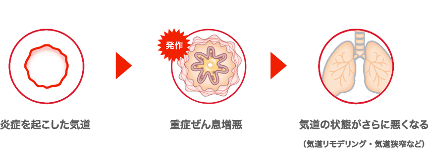 炎症を起こした気道→重症ぜん息増悪→気道の状態がさらに悪くなる（気道リモデリング・気道狭窄など）