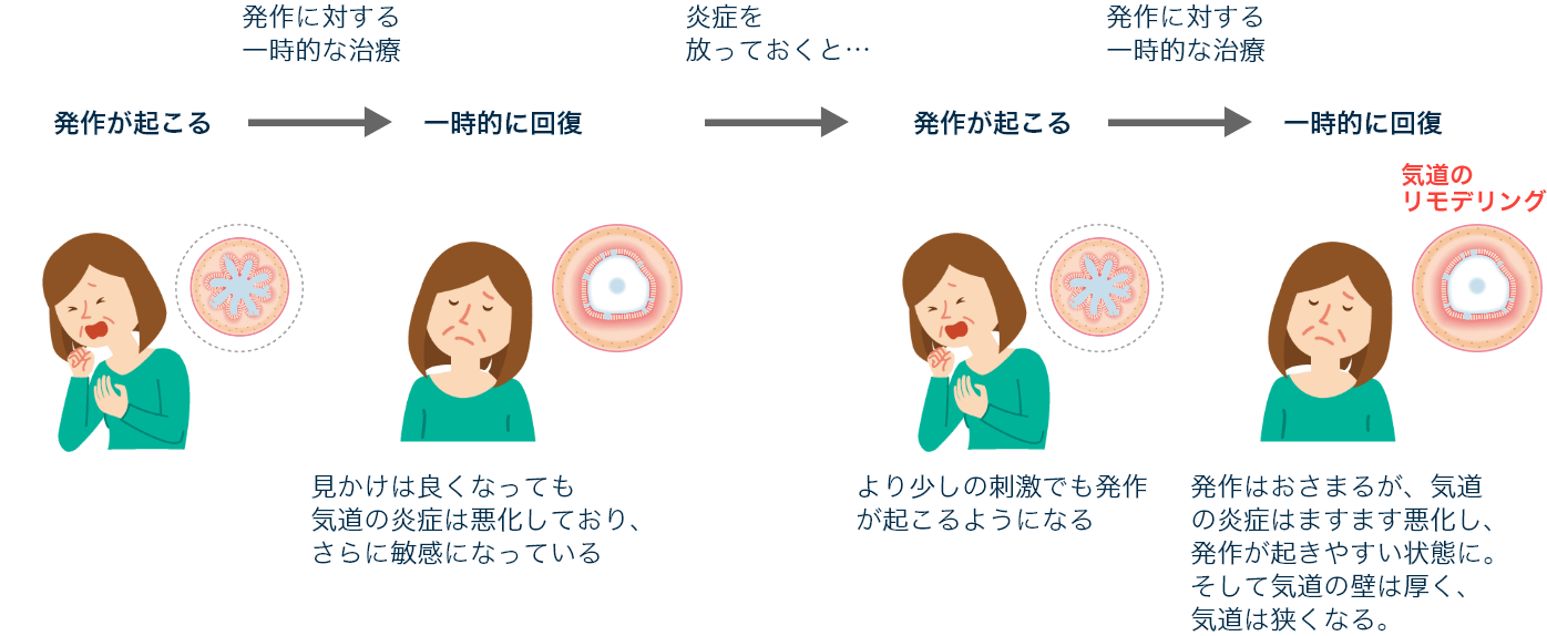 発作に対する一時的な治療 炎症を放っておくと… 発作に対する一時的な治療 発作が起こる 一時的に回復 発作が起こる 一時的に回復 見かけは良くなっても気道の炎症は悪化しており、さらに敏感になっている より少しの刺激でも発作が起こるようになる 発作はおさまるが、気道の炎症はますます悪化し、発作が起きやすい状態に。そして気道の壁は厚く、気道は狭くなる。